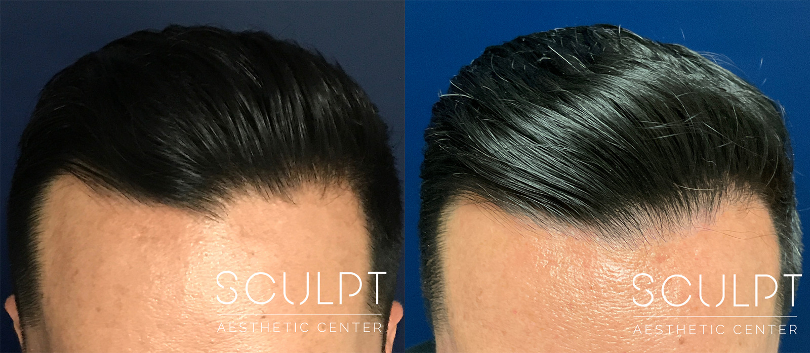 Hair Restoration Before and After Photo by Sculpt Aesthetic Center in Frisco, TX