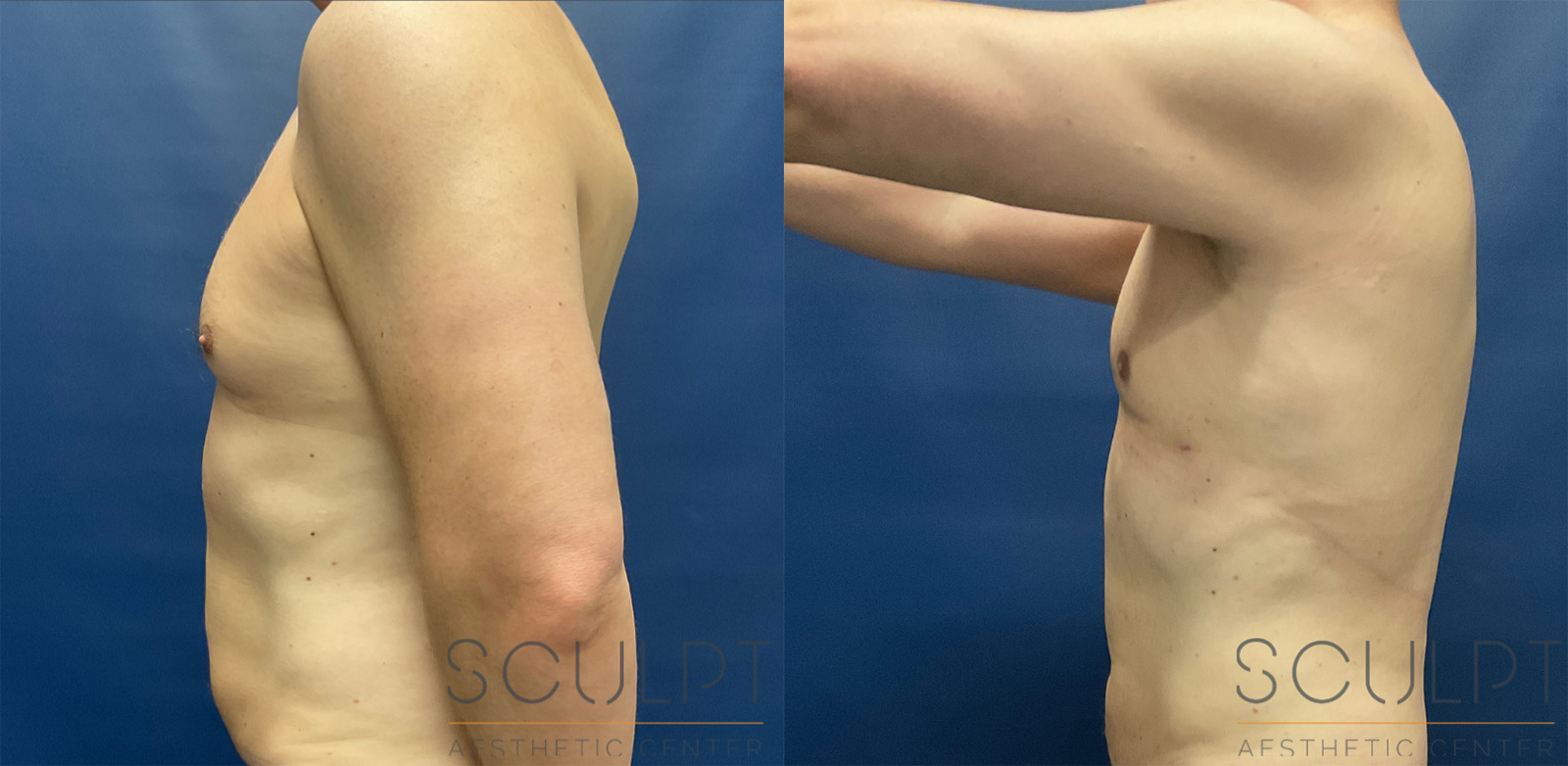 Male Liposuction Before and After Photo by Sculpt Aesthetic Center in Frisco, TX