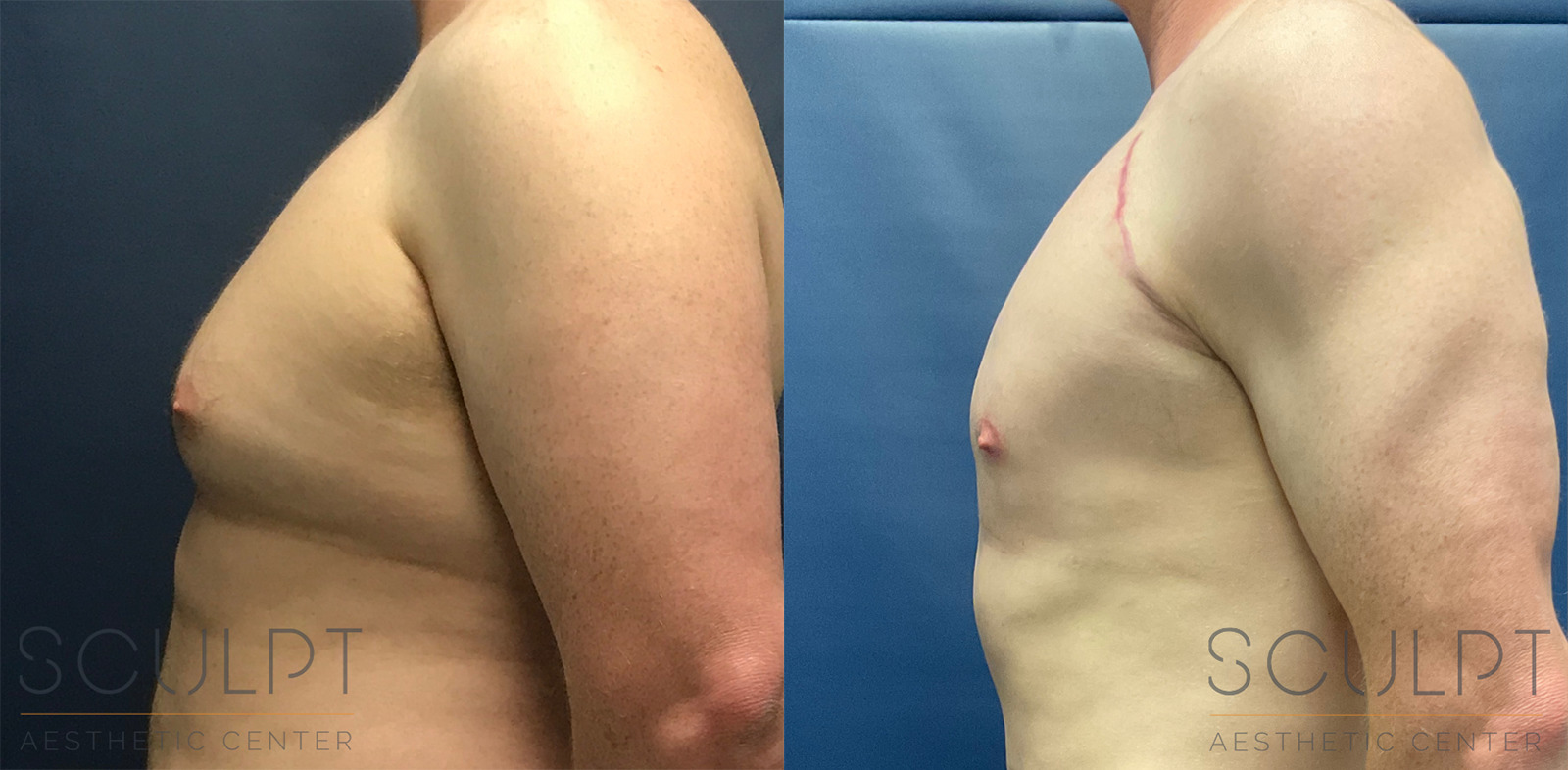 Male Breast Reduction Before and After Photo by Sculpt Aesthetic Center in Frisco, TX