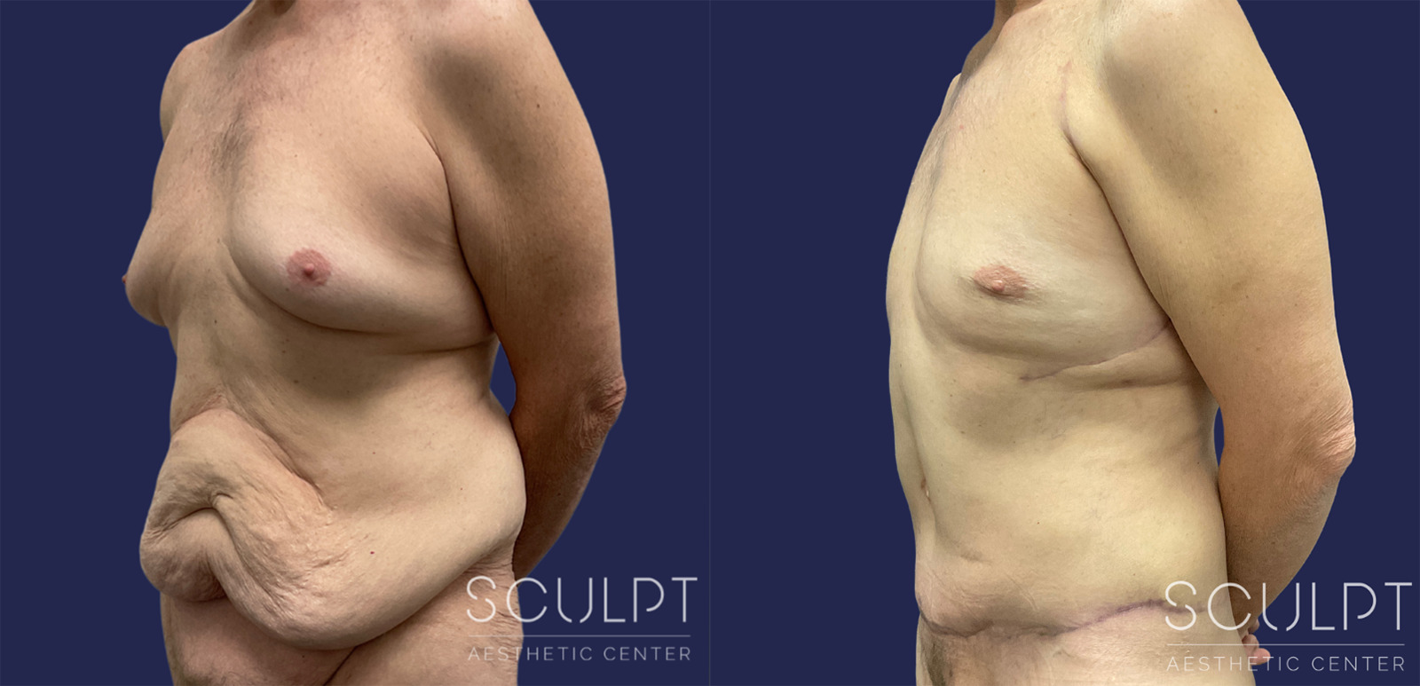 Male 360 Body Lift Before and After Photo by Sculpt Aesthetic Center in Frisco, TX