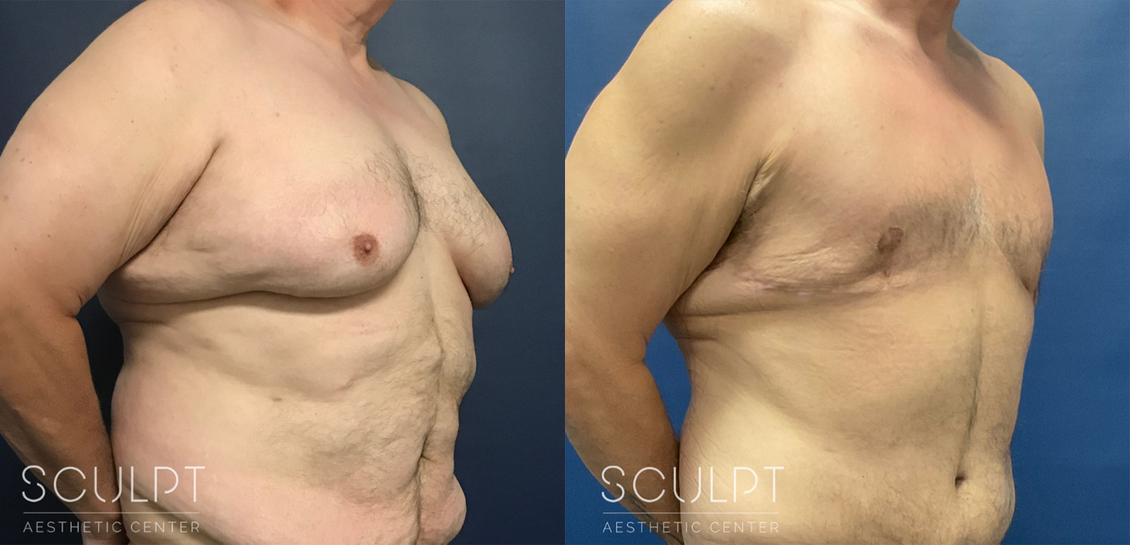 Male Skin Removal After Weight Loss Before and After Photo by Sculpt Aesthetic Center in Frisco, TX