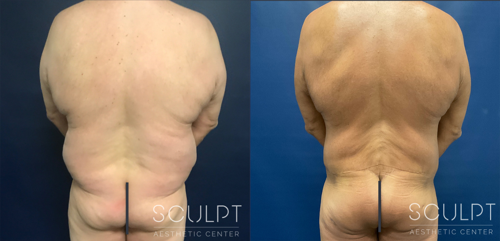 Male Skin Removal After Weight Loss Before and After Photo by Sculpt Aesthetic Center in Frisco, TX
