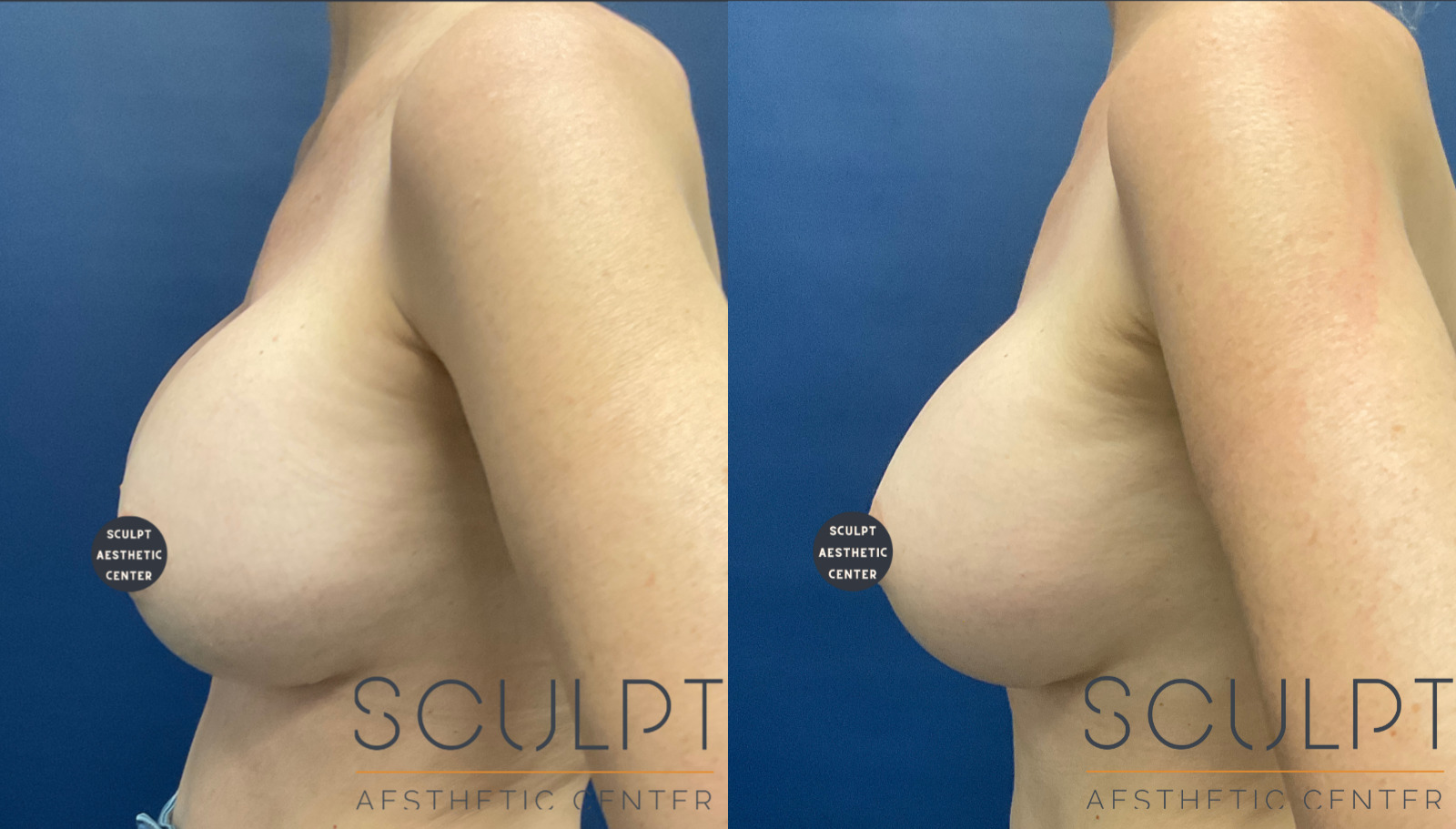 Breast Implant Exchange Before and After Photo by Sculpt Aesthetic Center in Frisco, TX