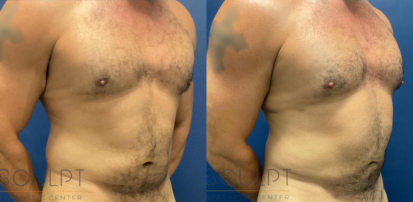 Male Liposuction Before and After Photo by Sculpt Aesthetic Center in Frisco, TX