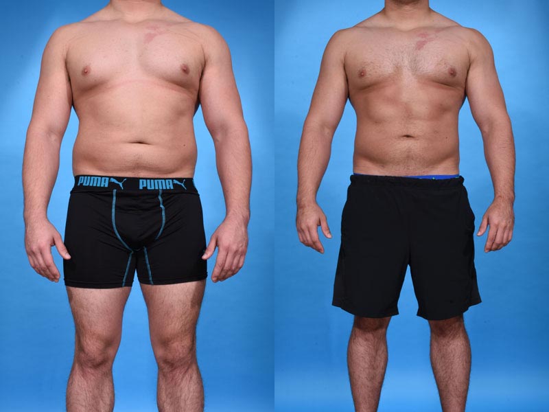 A before and after pick of a male patient's torso after having a tummy tuck from the best plastic surgeon in Frisco, TX.