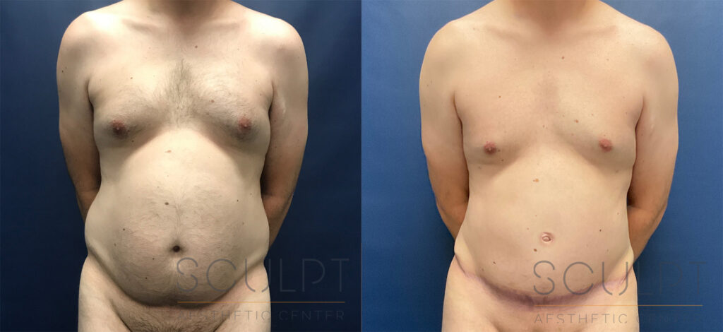 Male Tummy Tuck - Before & After Photo