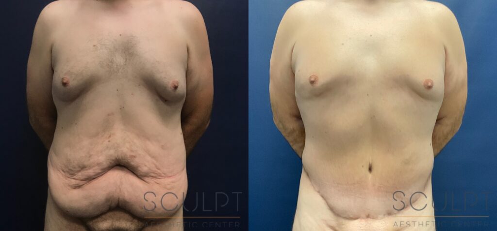 Skin Removal After Weight Loss - Before & After Photo