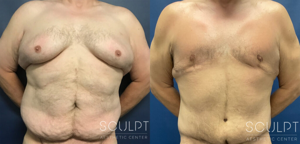 Skin Removal After Weight Loss - Before & After Photo