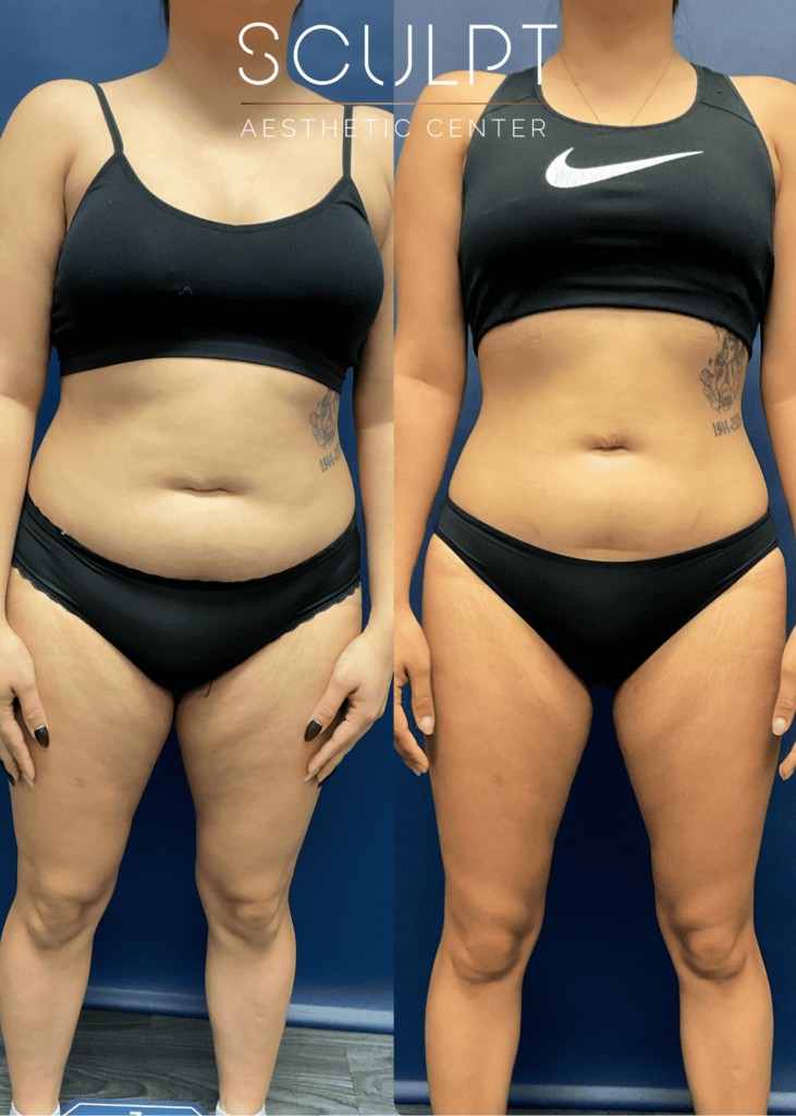 Before and after frontal view of female medical weight loss patient showing waist reduction after 2 months at SCULPT. To achieve this desired look and help fight cravings during the process, her treatment plan included GLP-1 in Frisco.