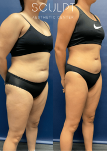 Before and after angled right profile of female patient highlighting reduced abdominal fullness and waist contour after 2 months of medical weight loss at SCULPT Aesthetic Center