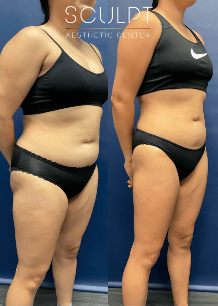 Before and after angled right profile of female patient highlighting reduced abdominal fullness and waist contour after 2 months of medical weight loss at SCULPT Aesthetic Center