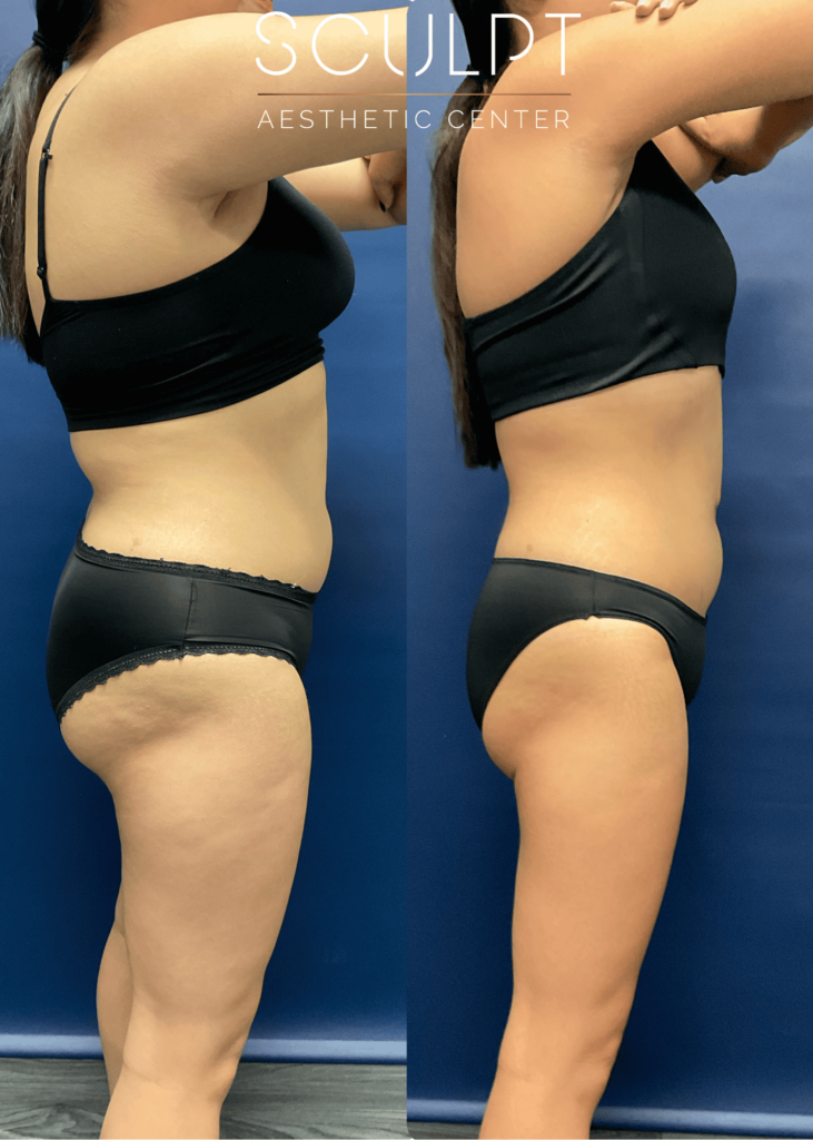 Before and after right profile image of female patient showing abdominal slimming and reduced belly projection after 2 months of medical weight loss at SCULPT. Part of her custom 360° approach included GLP-1 in Frisco.