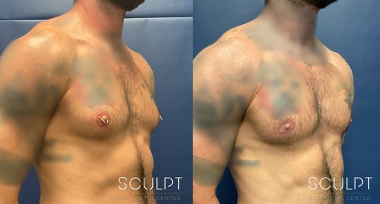 A before and after shot of a patient's chest who received extremely successful treatment for male gynecomastia in Dallas.